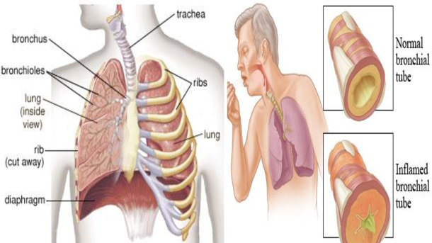 Image of Acute Bronchitis
